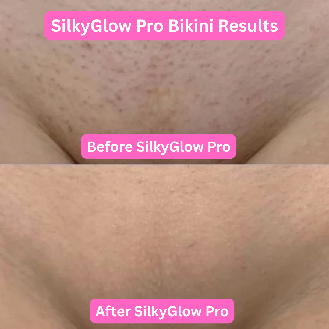 SilkyGlow Pro - Finally, a pain-free shave for sensitive skin ✨