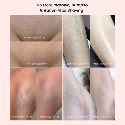 Black Friday Sale - SilkyGlow Pro - Finally, a pain-free shave for sensitive skin ✨